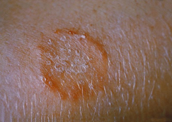 A round, scaly ringworm patch on skin with a raised red border and a clearer center